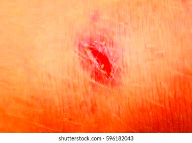 Scar On Human Skin Stock Photo 596182043  Shutterstock