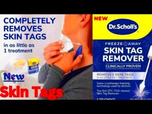 Dr Scholls Freeze Away Skin Tag Remover  YouTube