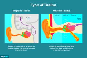 Understanding the Two Types of Tinnitus